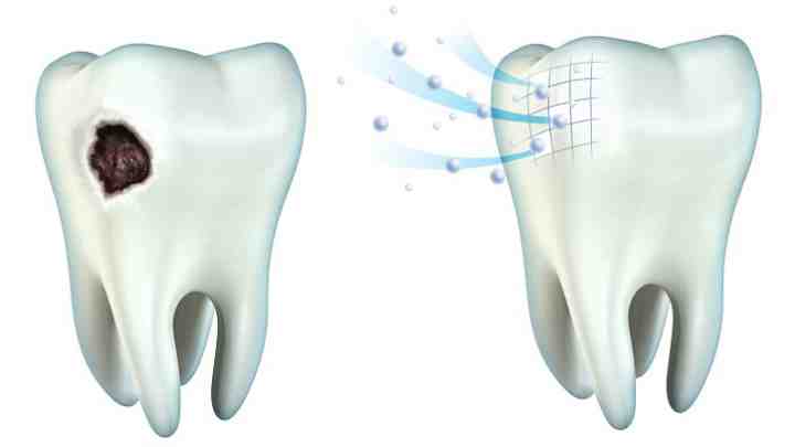 Реставрация эмали как один из методов реставрации зубов